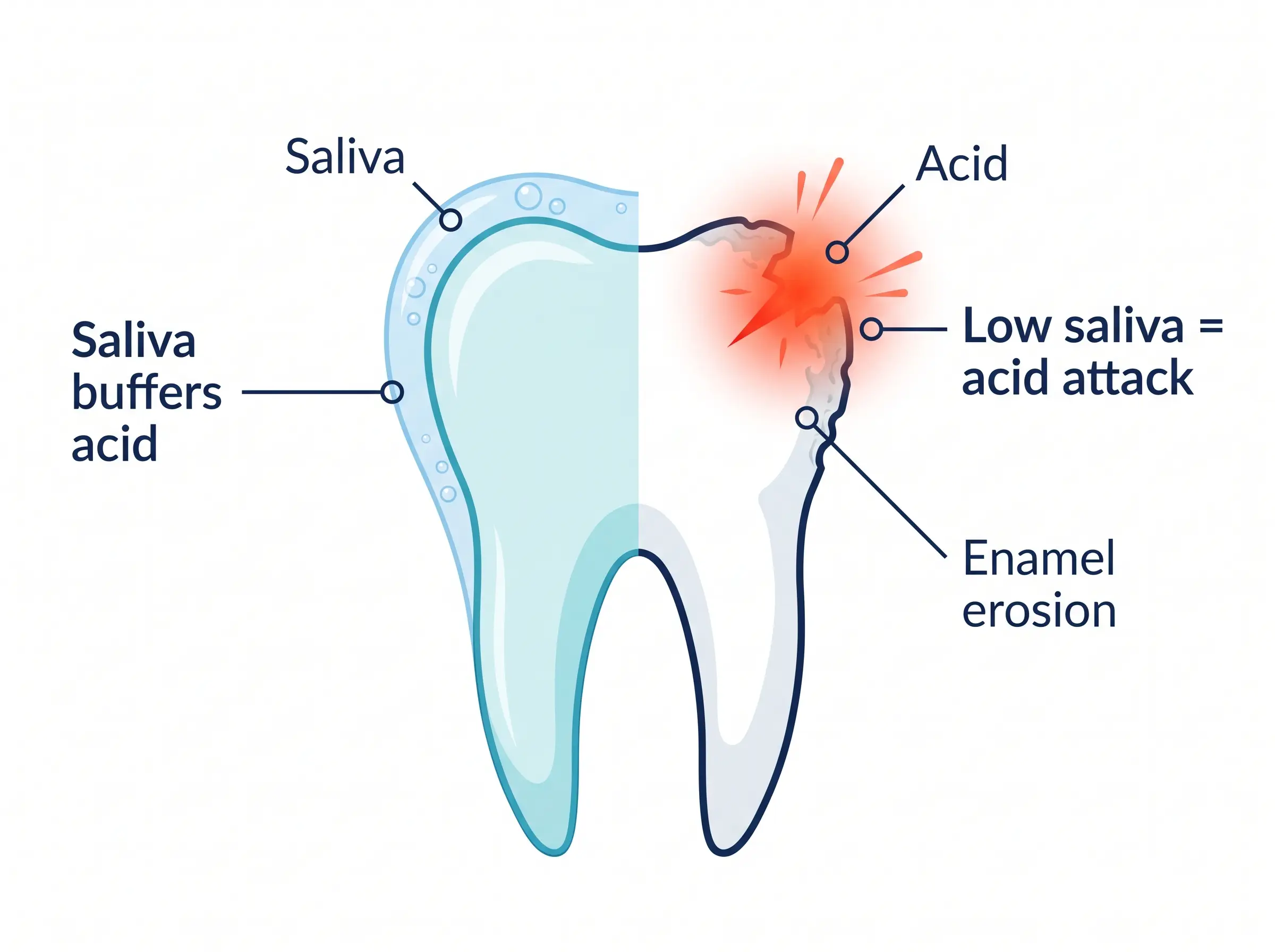 Diagram: saliva buffers acid; low saliva means acid attacks the enamel